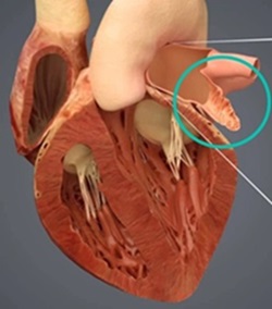 left atrial appendage