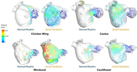 Flows throught different LAA morphologies